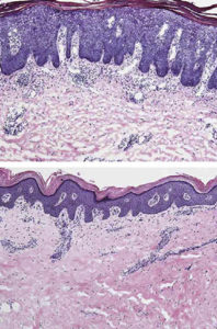 150313_krueger_psoriasis